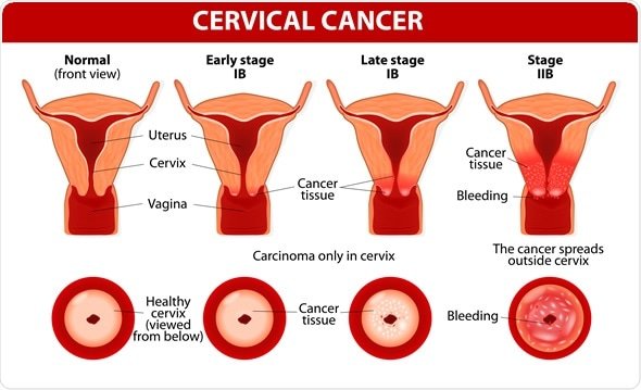 How to avoid cervical cancer