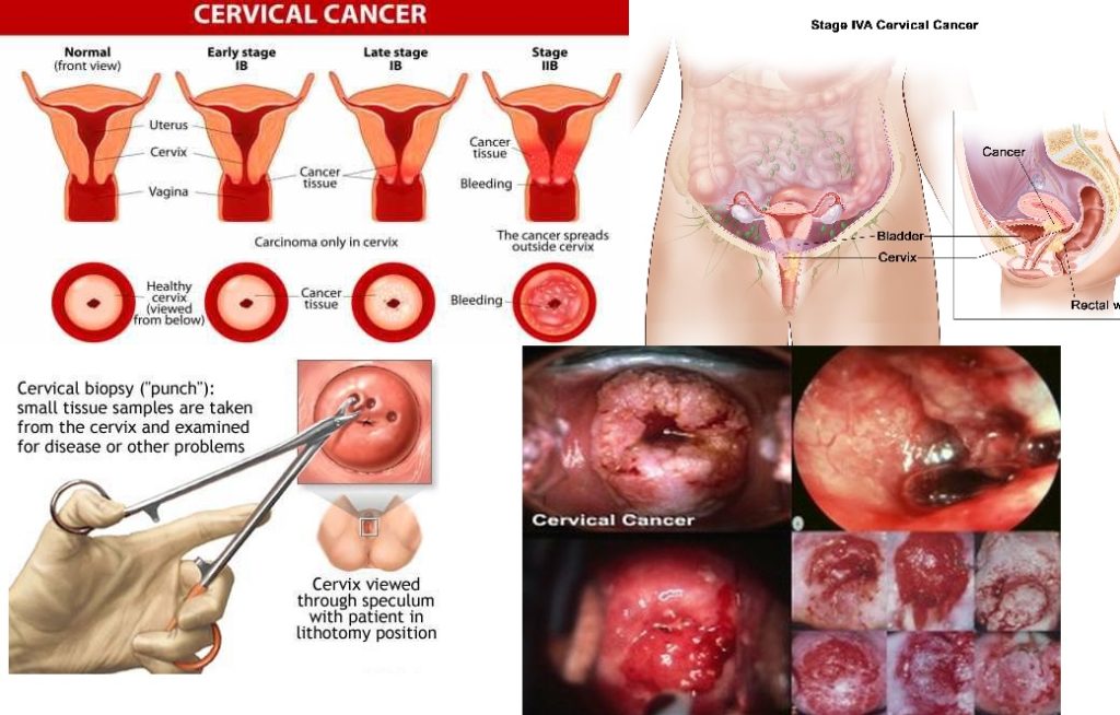 Cervical cancer jabs drive