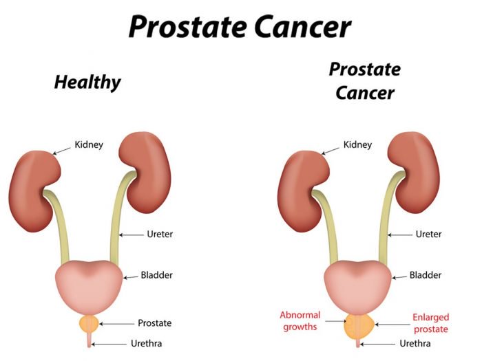 ABCs of Prostate cancer: Causes and Symptoms