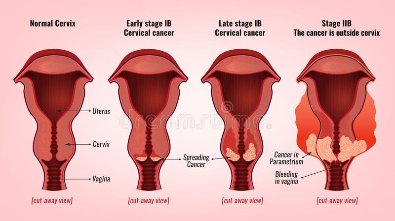 Cervical Cancer stages