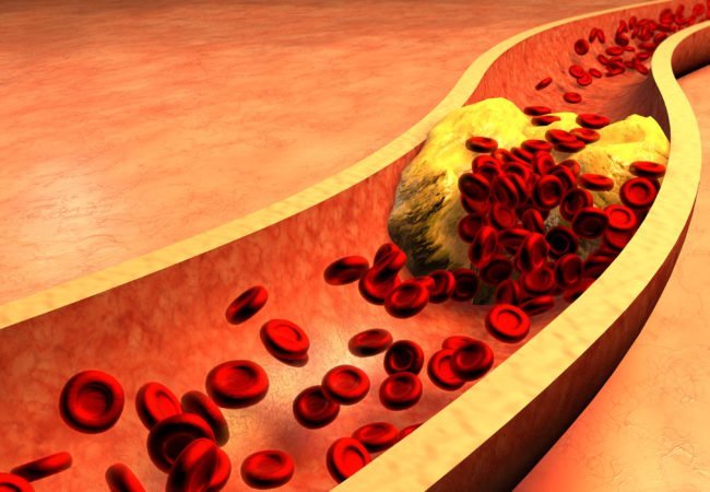 Control your cholesterol before it controls you