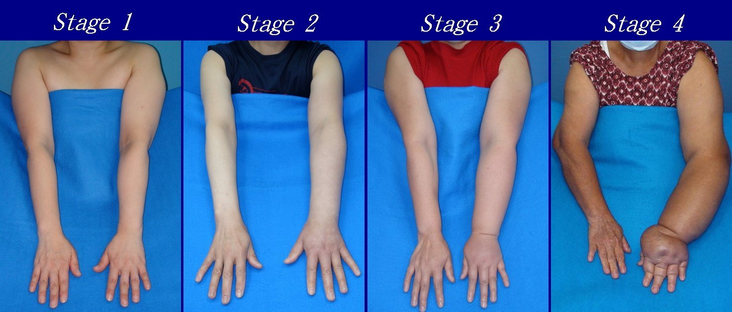 lymphedema stages on arms