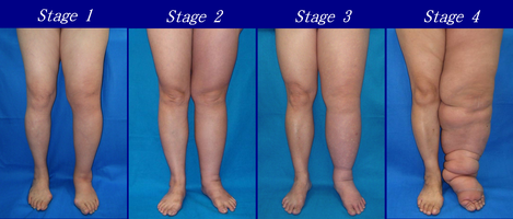 lymphedema stages on legs