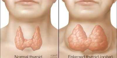 enlargement of thyroid