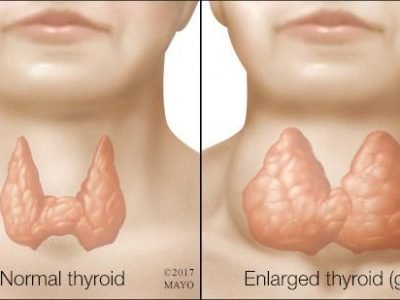 enlargement of thyroid