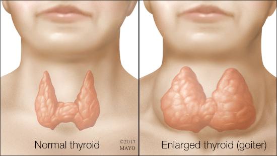 enlargement of thyroid